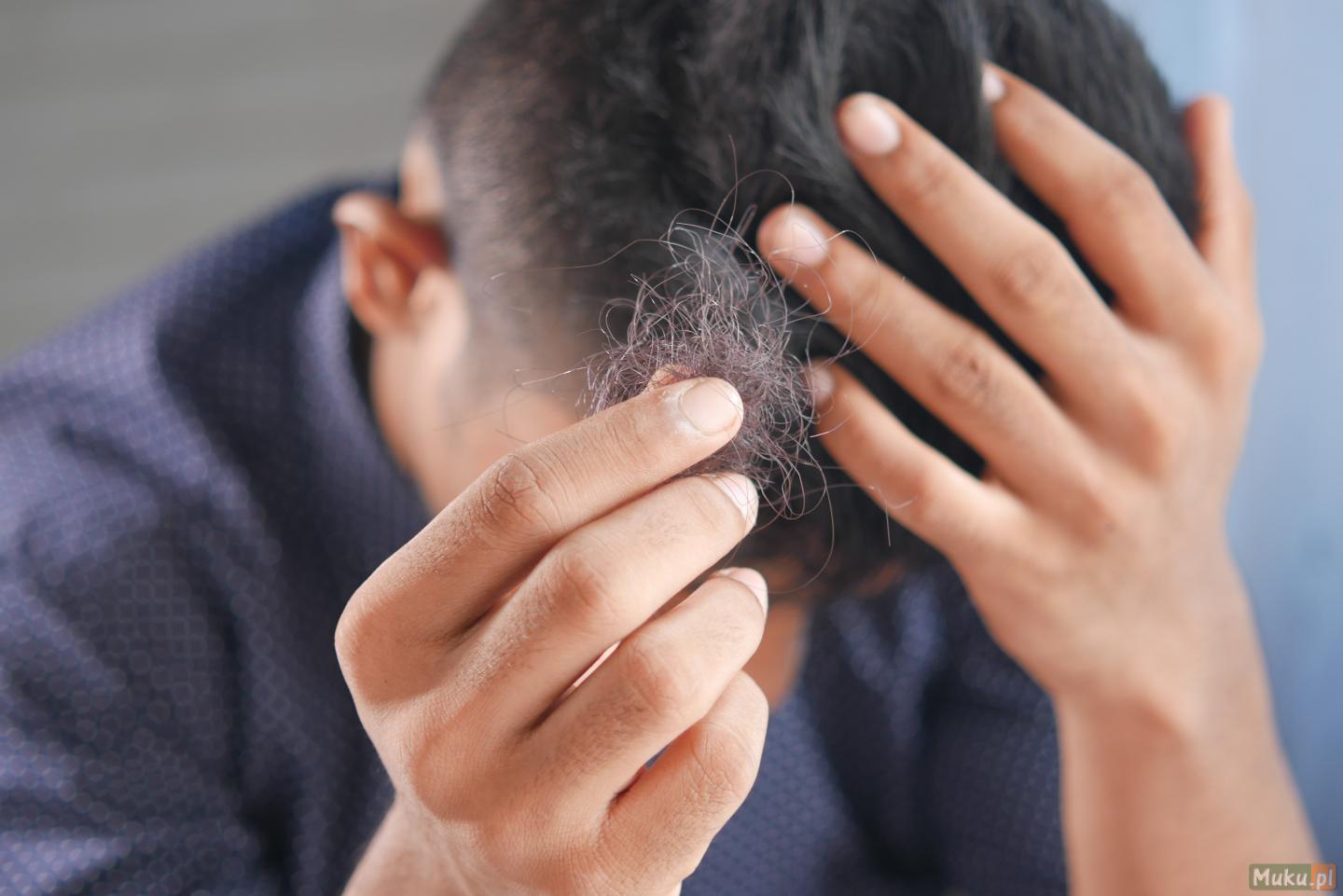 Łysienie u mężczyzn - Saifi Hair Transplant